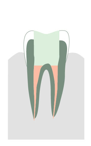 Obturation de la dent