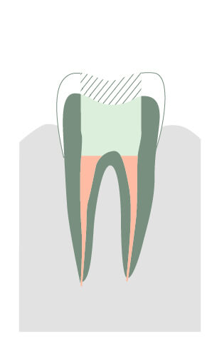Pancement dent